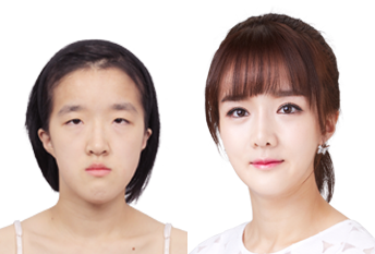 Operasi penonjolan dagu triple